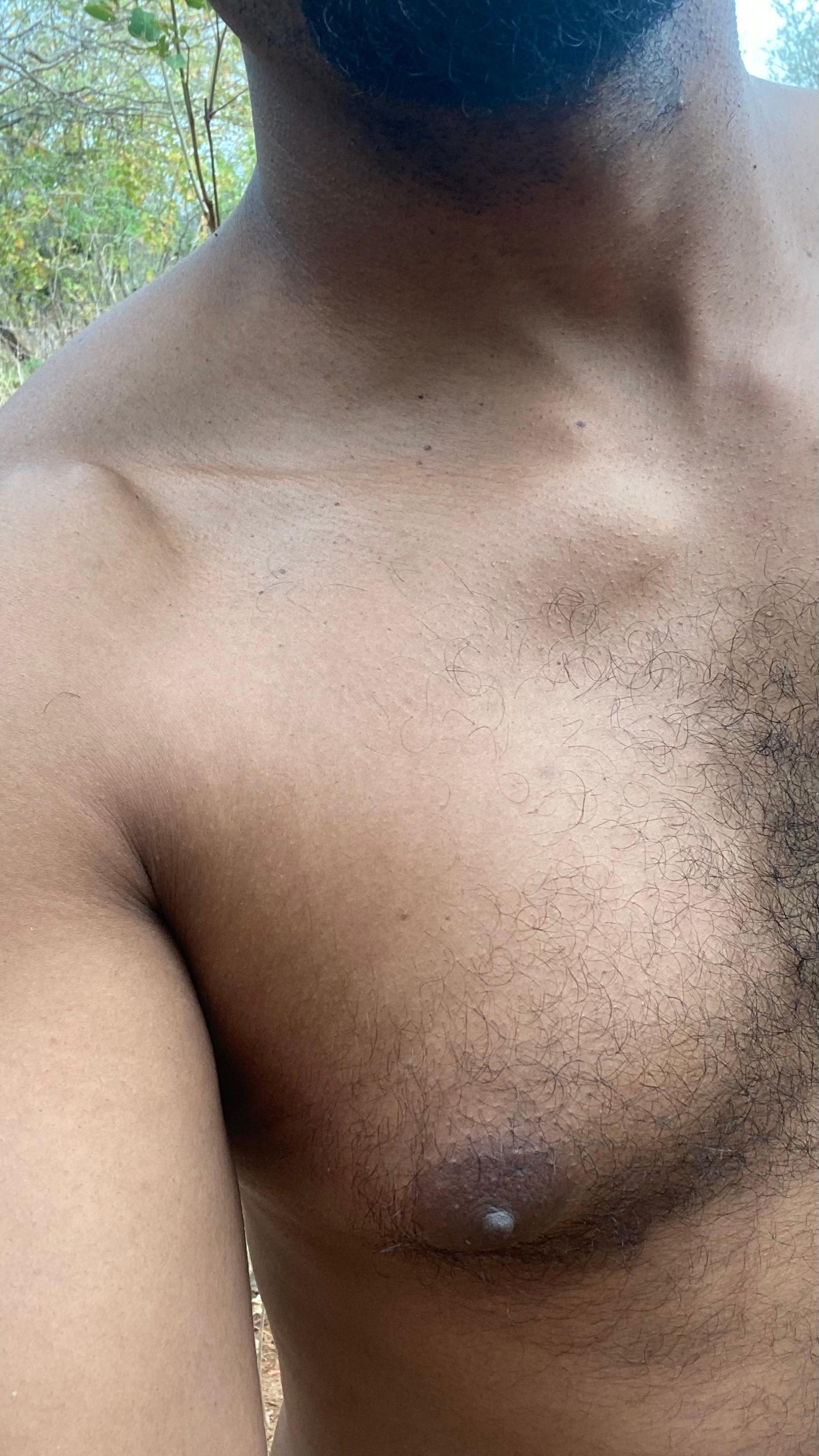 negrodovitiligo from Brazil